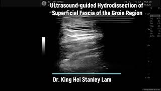 Ultrasoundguided Superficial Fascial Hydrodissection for Groin Region Distal to innguinal Ligament [upl. by Tahpos343]