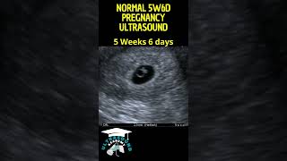 Early Pregnancy Ultrasound Short Quick Look into First Trimester pregnancyultrasound ultrasound [upl. by Wright614]