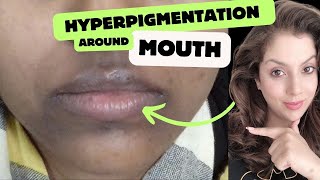 Hyperpigmentation around the mouth treatment amp causes  Nipun Kapur [upl. by Luo]