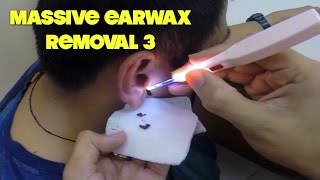 Massive Earwax Removal 3 Super Dark Earwax [upl. by Dareen]