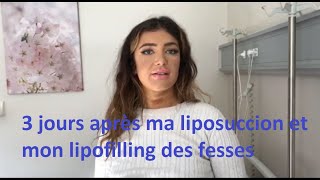 Chirurgie esthétique Tunisie – Liposuccion et lipofilling des fesses avec Chirurgiedirect [upl. by Muns]