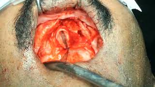 part 1  Transnasal  Pterygoid  Nasomaxillary buttress implants to avoid quad zygoma l chennai [upl. by Gnahc]