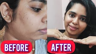 how i removed dpn and got clear skin🦋cost painaftercare [upl. by Ajaj36]