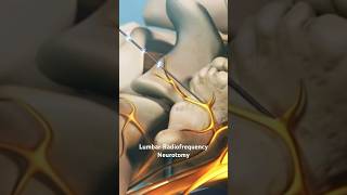 Lumbar Radiofrequency Neurotomy [upl. by Basso]