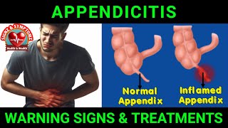 Appendicitis Symptoms and Treatment Options appendicitis [upl. by Wendin827]