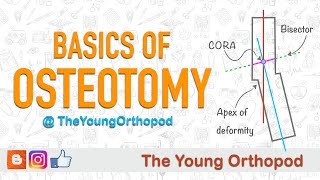 Basics of Osteotomy [upl. by Mears]