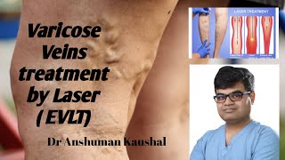 Varicose veins treatment explained  Laser treatment of Varicose veins  EVLT  वेरिकोस वेन्स उपचार [upl. by Eam]