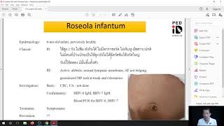 Mini lecture 30 Case demonstration Roseola infantum [upl. by Bertasi144]