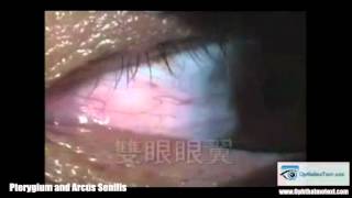 Pterygium and Arcus Senilis [upl. by Mcintyre]