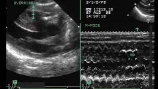 Tetralogy of Fallot with Vertically Oriented PDA [upl. by Oiramd]