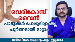 വെരികോസ് വൈൻ പാടുകൾപോലുമില്ലാതെ പൂർണമായി മാറ്റാം  Varicose vein removal  Arogyam [upl. by Arateehc]