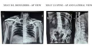 A Case of Ochronosis with Severe Bilateral Osteoarthritis Knee [upl. by Euqirne]