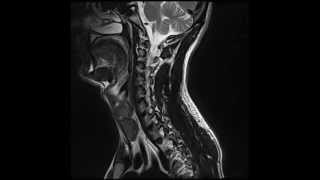 MRI  Incomplete T7 Spinal Cord Injury [upl. by Lissner]