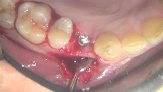 erbium laser for single implant positioning incision and flap mobilization [upl. by Novyar]