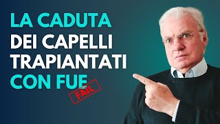 La caduta dei capelli trapiantati con la tecnica FUE [upl. by Ancilin]