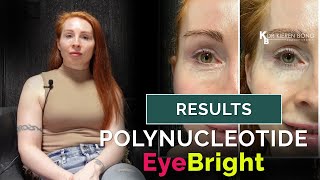 Polynucleotide EyeBright  Botox  Polynucleotide high dose for maximum result Glasgow Edinburgh [upl. by Ydak]