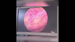 Laparoscopic Umbilical hernia repairIPOM PLUS [upl. by Nosirrah]