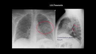 Chest Xray Cases 1 [upl. by Lowndes]