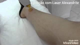 Método de Epilação com Laser Alexandrite [upl. by Judy]