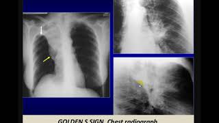 Imaging of bronchogenic carcinoma [upl. by Nancy]