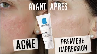 ACNE  Une journée avec la BB Crème La Roche Posay Test  1ère Impression [upl. by Ynelram]