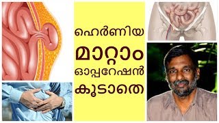 Treatment for Hernia without operation  Mohanan Vaidyar [upl. by Press410]