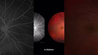 ¿Qué causa la retinopatía diabética salud diabetesmellitustipo2 prevencióndeenfermedades [upl. by Latoya]