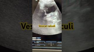 Vesical Calculi Cystoliths videos reels urinarybladder stones calculus cystitis ultrasound [upl. by Byrann]