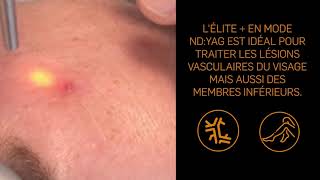 Tutoriel n°6  Traitement dun angiome stellaire avec le laser Elite par le Dr Patarin [upl. by Airbmat]