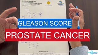 Gleason Score Prostate Cancer  What is Gleason 6  7 8 9 10 [upl. by Artenek438]