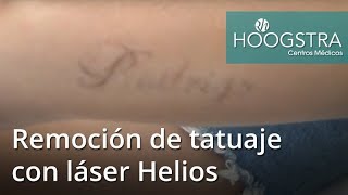 Remoción de tatuaje con láser Helios 18233 [upl. by Rephotsirhc]