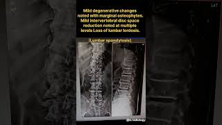 X RAY OF LUMBER SPINE AP amp LAT FINDINGS [upl. by Essam543]