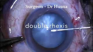 Double rhexis in intumescent cataract [upl. by Repohtsirhc]