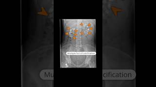 Medullary nephrocalcinosis due to type 1 renal tubular acidosis virlshorts [upl. by Atinat]