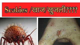 स्केबीज खाज  खुजली scabies scabies scabiestreatment [upl. by Gnivre]