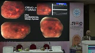 AIOC2024 GP137 Topic Dr Paritosh Arvind Kamdar Frankenstein Findings on Fundus examination and Ima [upl. by Yonina]