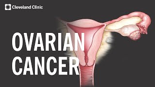 5 Warning Signs and Risk Factors of Ovarian Cancer [upl. by Fantasia706]