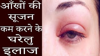 आंखों की सूजन खत्म करने के घरेलू उपाए  Home Remedies For Puffy Eyes  Eye Bags Home Remedies [upl. by Gereron]