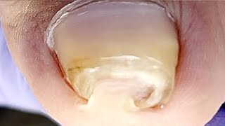 Curly Ingrown Toenails Leave Huge Damage To Toes【Xue Yidao】 [upl. by Attenoj]