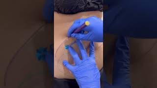 Benefits of CoolSculpting  Skinlab drjamunapai skincare beautyadvice [upl. by Htabmas452]