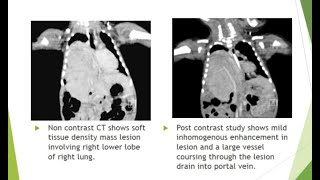 CASE OF THE WEEK  BRONCHOPULMONARY SEQUESTRATION [upl. by Nohsal]