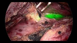 Fluorescence guided esophagectomy  Left bronchial dissection [upl. by Dlonyar]