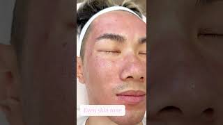 microneedling potenza rejuran skintightening largepores acnescars clearskin medspa [upl. by Acilegna]