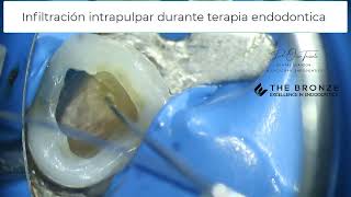 Anestesia intrapulpar durante terapia endodontica [upl. by Rockie763]