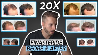 20 Finasteride Before And After Results NW1  NW5NW6 [upl. by Evey]