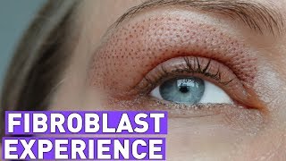 FIBROBLAST treatment experiencebefore and after 7 days [upl. by Yahsel]