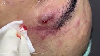 Big Cystic Acne Blackheads Extraction Blackheads amp Milia Whiteheads Removal Pimple Popping [upl. by Noivert92]