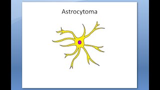 Pathology 895 a Astrocytoma Glioma Grade Pilocytic glioblastoma multiforme microscopy histology [upl. by Breana905]