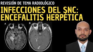 Radiología en 5 minutos Infecciones del sistema nervioso central Encefalitis herpética [upl. by Eichman261]