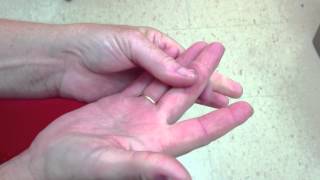 Raynaud Scleroderma treatment 1 month follow up visit [upl. by Nrubyar277]